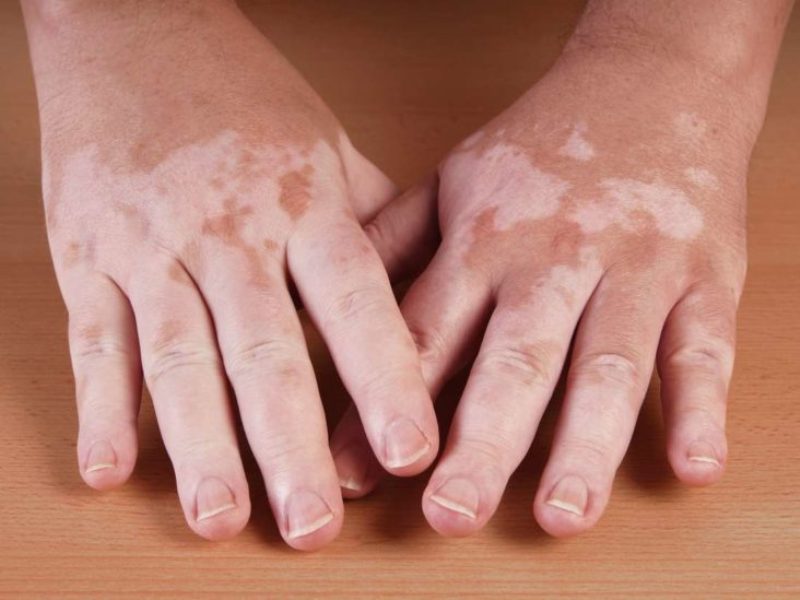 Vitiligo Treatment