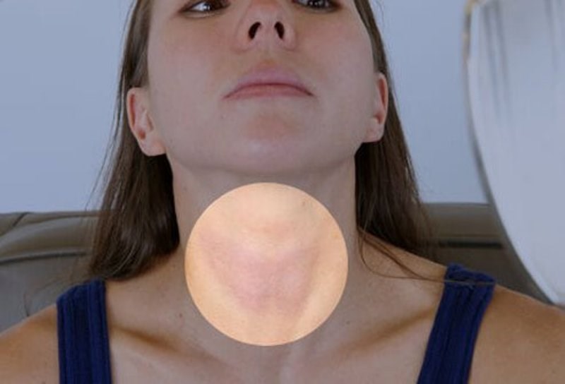 Thyroid